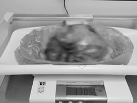 Phát hiện "thứ đáng sợ" nặng hơn 3kg trong bụng người phụ nữ 42 tuổi