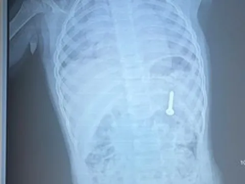 Đang chơi ở nhà, bé gần 2 tuổi nuốt phải thứ "đáng sợ"