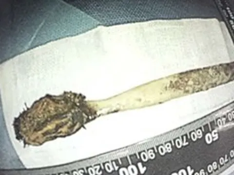 Đau bụng đi khám, người đàn ông "sốc" phát hiện bàn chải nằm trong bụng 52 năm