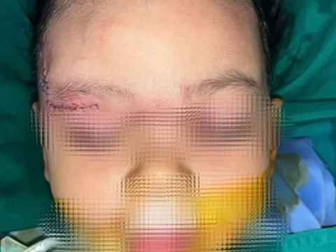 Bé 22 tháng tuổi bị chó cắn: Bác sĩ xử trí nhanh, hạn chế biến chứng