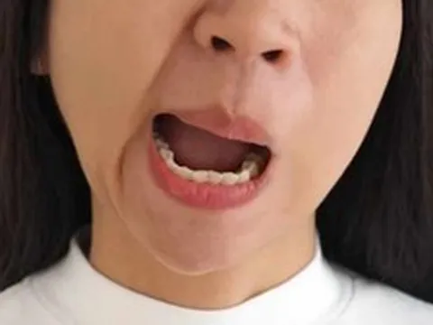 Cảnh báo bệnh liệt mặt "tấn công" giữa mùa hè: Đừng chủ quan với những "thủ phạm" ở ngay trong nhà