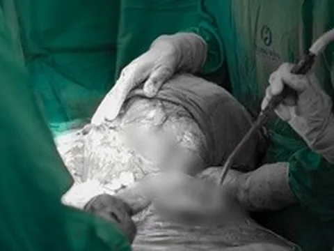 Người phụ nữ ở Hà Nội suy kiệt vì mang khối u khổng lồ 5kg