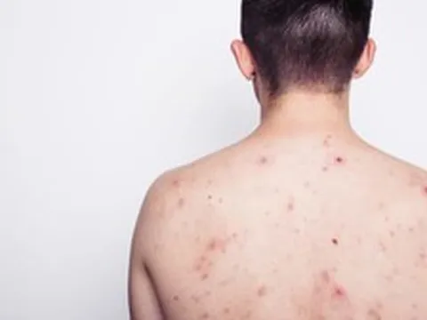 Nam thanh niên 23 tuổi nhiễm HIV sau khi tham gia lễ hội té nước tại Thái Lan