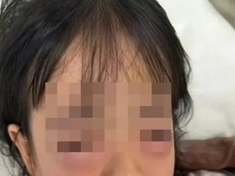 Bé gái 5 tuổi nhập viện, mắt sưng vù sau khi chơi bong bóng xà phòng