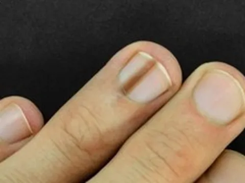 Bác sĩ bệnh viện trung ương cảnh báo: 5 dấu hiệu trên móng tay cần nghĩ tới ung thư ác tính