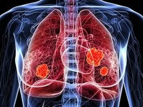 Con số đáng lo ngại về ung thư phổi tại Việt Nam