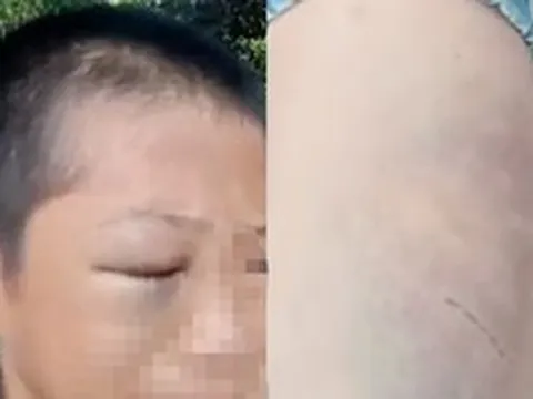 Xôn xao clip bé trai mắt bầm tím, khóc kêu cứu vì nhiều lần bị đánh đập khi ở cùng bố và vợ mới