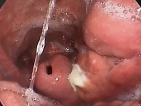 Hà Nội: Người đàn ông 66 tuổi tắc đường thở, phải nhập viện cấp cứu vì thói quen nhai đá lạnh giải nhiệt