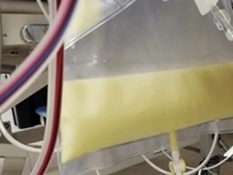 Người đàn ông 40 tuổi đau bụng dữ dội sau bữa ăn no, bác sĩ rút ra toàn máu đục như nước gạo, nhớt như mỡ