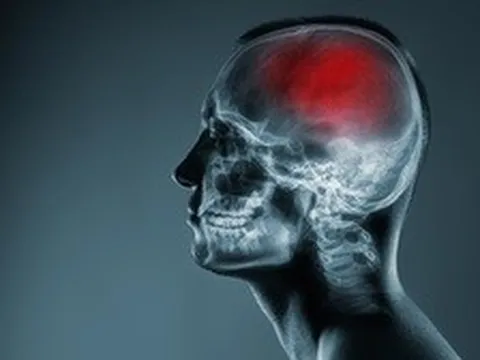 Nghiên cứu mới về đột quỵ lật đổ quan niệm y học hàng thập kỷ