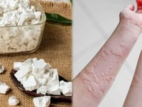 Trong nhà có bột sắn dây: Pha ngay theo cách này để cơ thể THẢI ĐỘC, đánh bay mẩn nNgứa, mề đay mùa nắng nóng