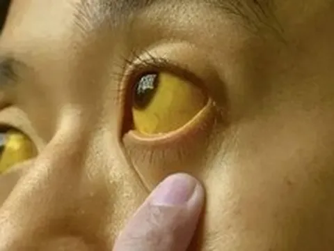 Nếu mắt có 6 thứ, đi khám ung thư ngay còn kịp!