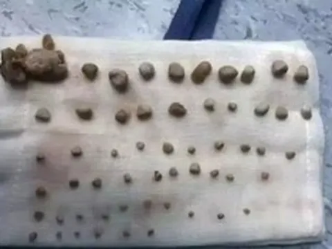 Bé trai 9 tuổi nhập viện khẩn cấp, bố mẹ "sốc" khi bác sĩ lấy ra thứ "đáng sợ" từ bụng con