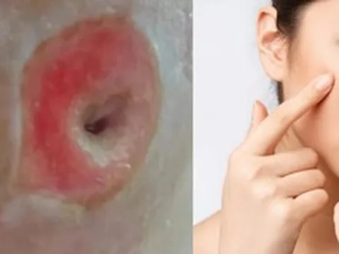 Người phụ nữ 40 tuổi chết lặng khi thấy mặt như "tổ ong" vì sai lầm ai cũng dễ mắc