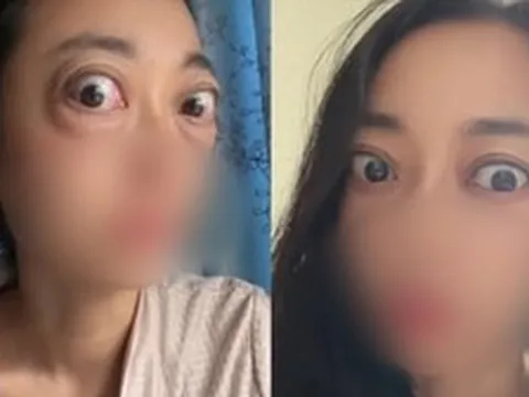 Nhìn đôi mắt "ếch" của người phụ nữ, ai cũng thương, câu chuyện phía sau là bài học cảnh tỉnh nhiều người trẻ