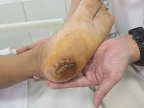 Bệnh viện Bạch Mai cảnh báo: Nhiều người đang phải nhập viện thở máy vì 1 căn bệnh do chủ quan vết thương nhỏ
