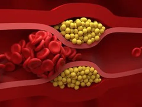 Không cần thực phẩm đắt tiền, bác sĩ chỉ 4 món quen thuộc giúp giảm cholesterol “cực đỉnh”