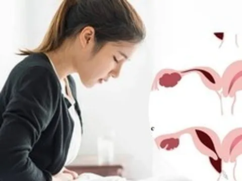 Đau bụng kinh suốt nhiều năm, nữ sinh 18 tuổi phát hiện dị tật hiếm: Bác sĩ bất ngờ khi thấy vòi tử cung đã hoại tử