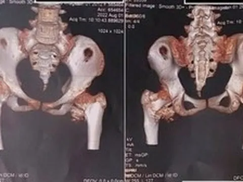 Bé gái 12 tuổi mắc "hội chứng người hóa đá" hiếm gặp, bố mẹ ngỡ ngàng khi bác sĩ nhắc tới cú ngã xe đạp 2 năm trước