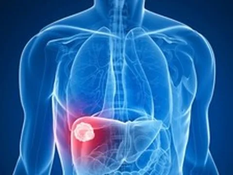 Cảnh báo 3 ĐIỀU bất thường có thể liên quan đến ung thư gan mà nhiều người Việt chủ quan bỏ qua