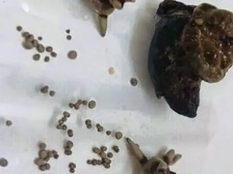 Bệnh sỏi thận: Vì sao trong cùng 1 quả thận lại có các viên sỏi khác nhau và chia sẻ của bác sĩ "không còn phải bổ đôi quả thận tìm sỏi"