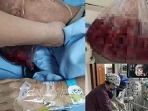Người đàn ông nôn ra hơn 2 lít máu trong 5 phút, bác sĩ cảnh báo: 4 thói quen ăn uống "phá nát" dạ dày
