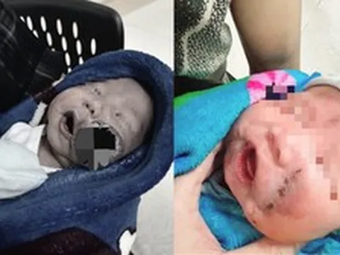 Nửa khuôn mặt bị u máu chiếm chỗ... và một cuộc chạy đua với từng giọt máu cứu sống em bé mới 1 tháng tuổi