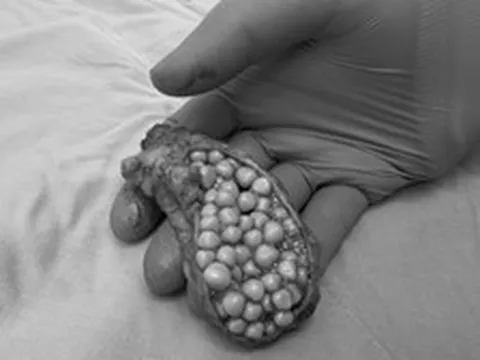 Người phụ nữ 38 tuổi đau bụng suốt 1 tháng, đi khám bác sĩ phát hiện “khối u bí ẩn” chứa 130 viên sỏi trông như “bọc trứng cá”
