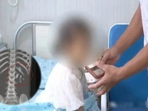 Bé gái 5 tuổi 2 năm không cao thêm, không tăng cân, đi khám bác sĩ phát hiện 1 thứ phủ đầy thận trái